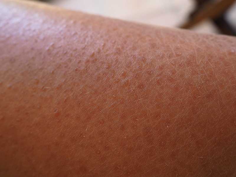 Гусиная кожа на руках. Keratosis pilaris (фолликулярный гиперкератоз). Фолликулярный дериатоз. Волосяной лишай Девержи.