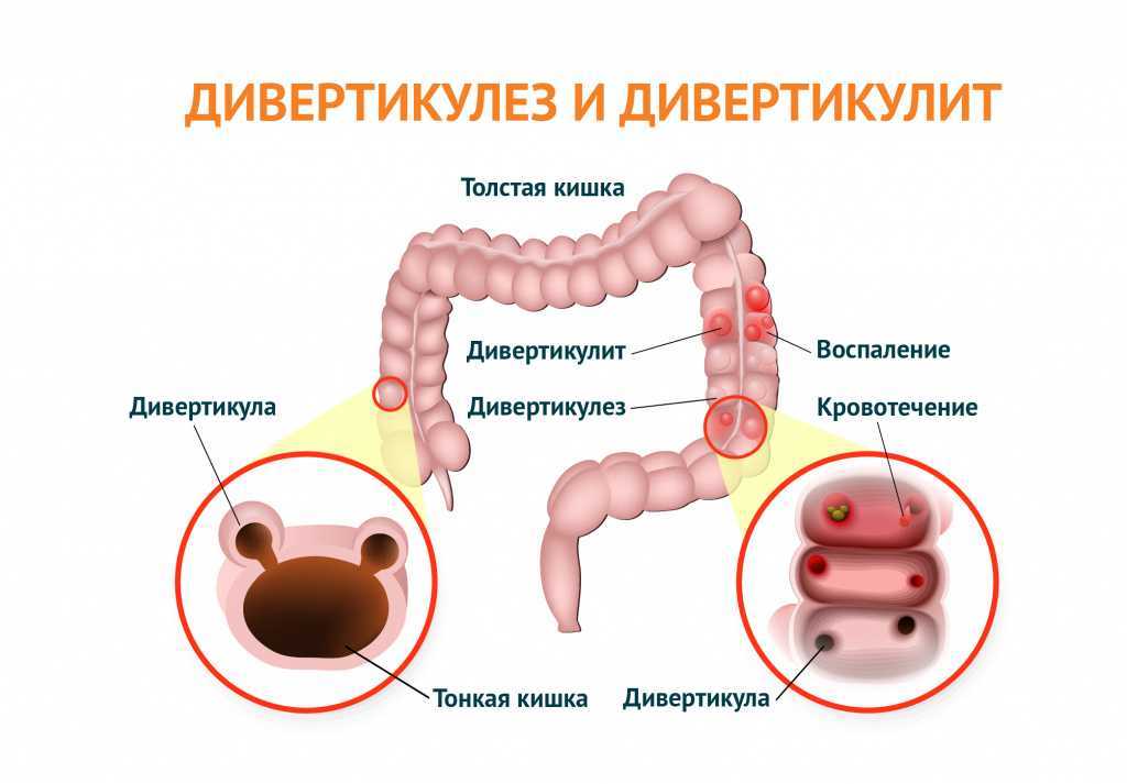 Дивертикул кишечника картинки