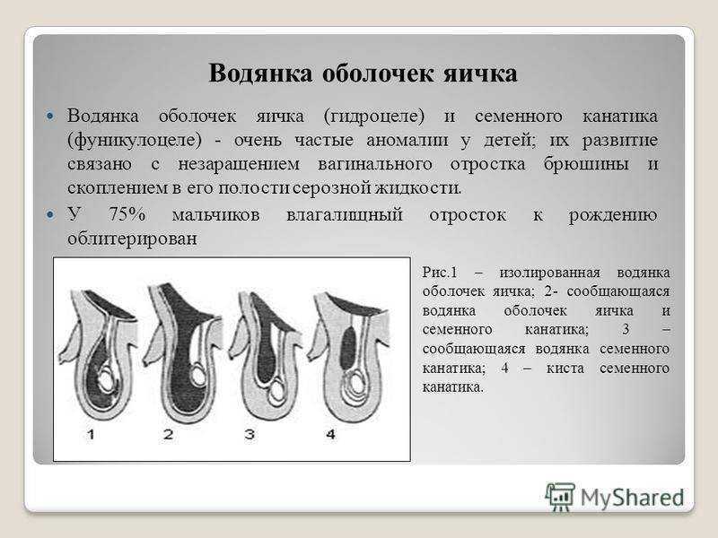 Водянка яичка (гидроцеле): причины, симптомы, диагностика и лечение — клиника «доктор рядом»