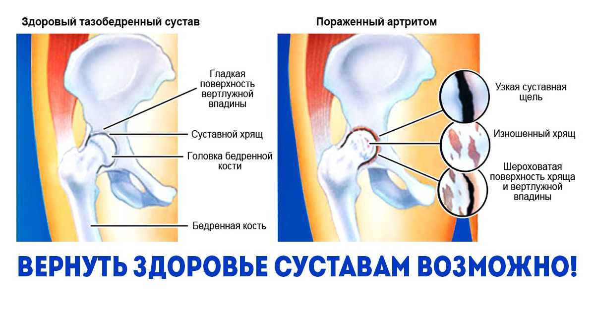 Артрит тазобедренного сустава фото