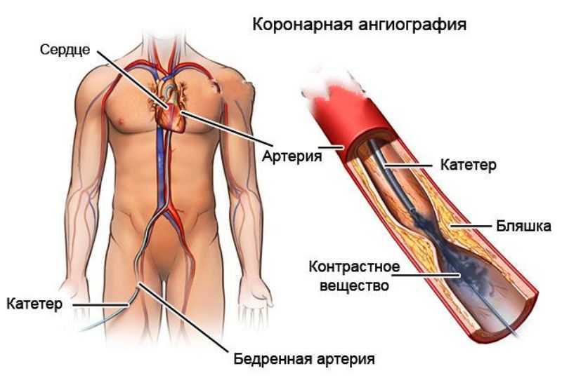 Сосуды сердца схема коронарография