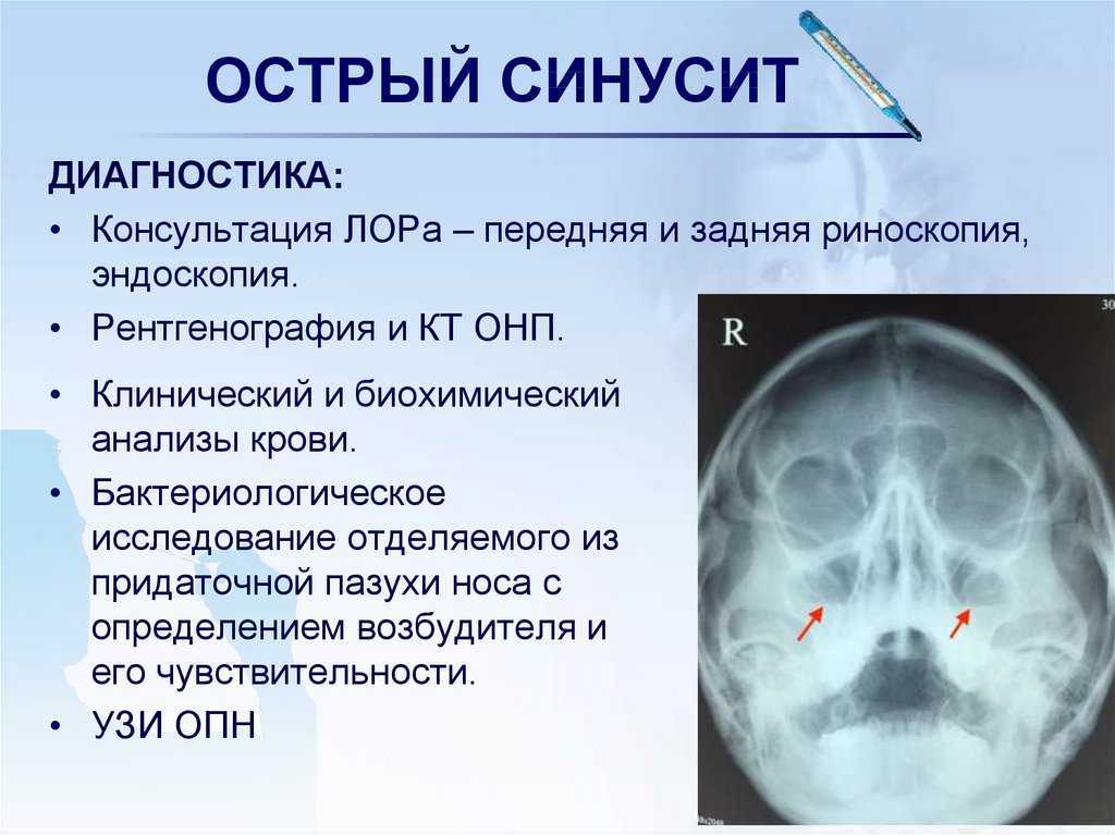 Острый гнойный гайморит: симптомы и лечение