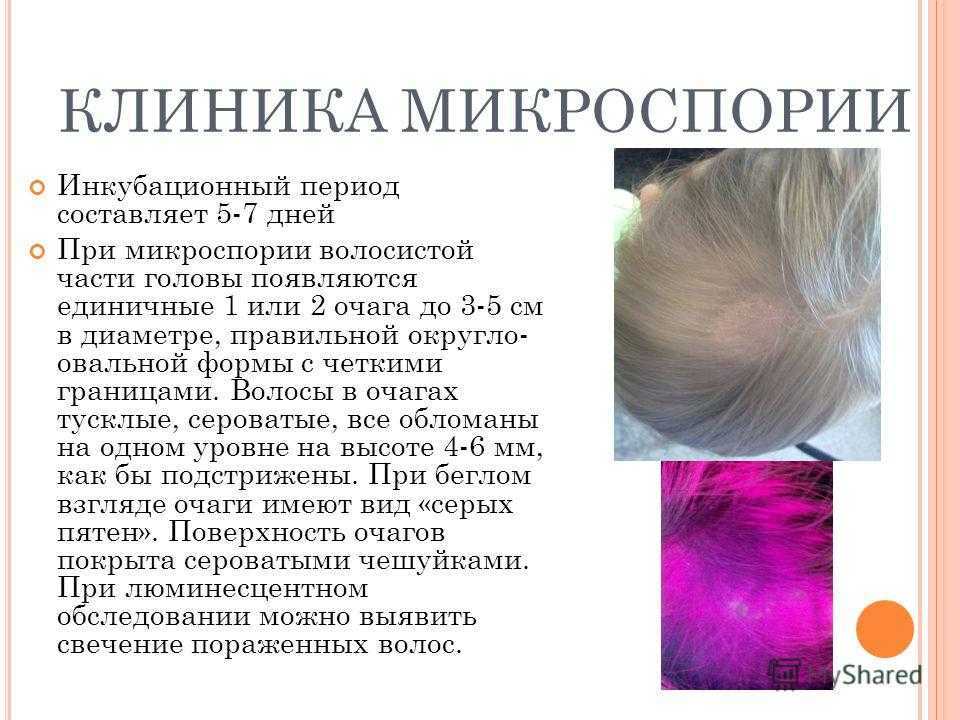 Микроспория у человека: симптомы, фото, лечение. чем лечить микроспорию