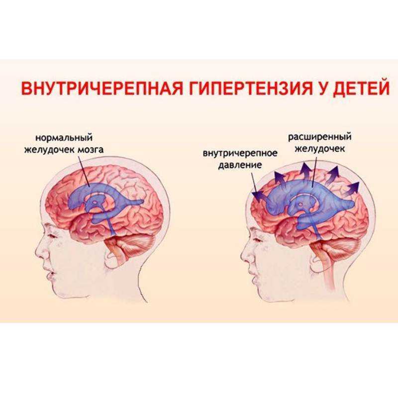 Лечение внутричерепного давления. Внутричерепная гипертензия симптомы. Повышение внутричерепного давления. Синдром внутричерепной гипертензии. Давление Черепного мозга.