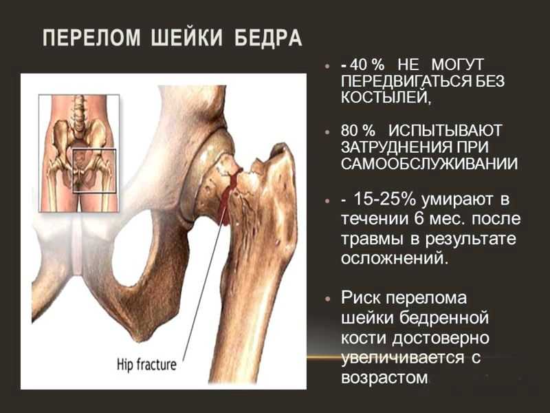 Перелом шейки бедра презентация