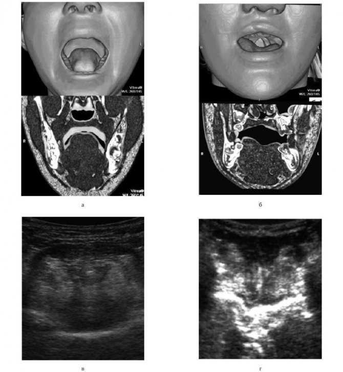 Расщелина губы на узи фото
