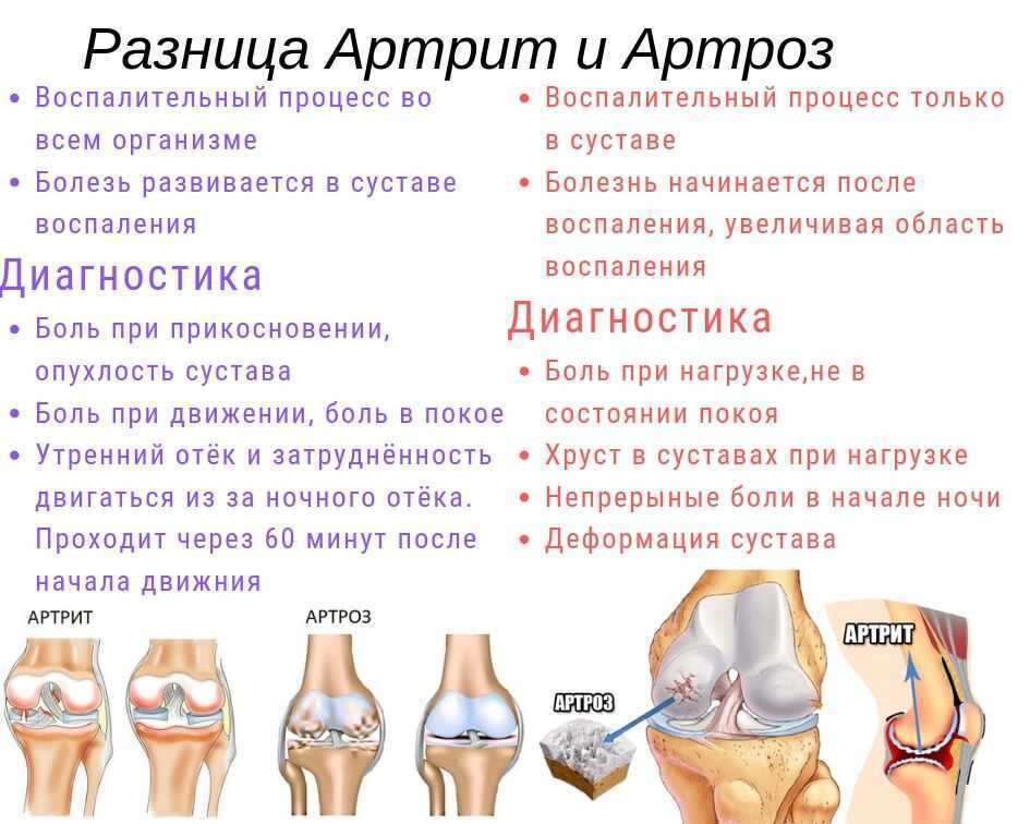 Воспаление суставов.!