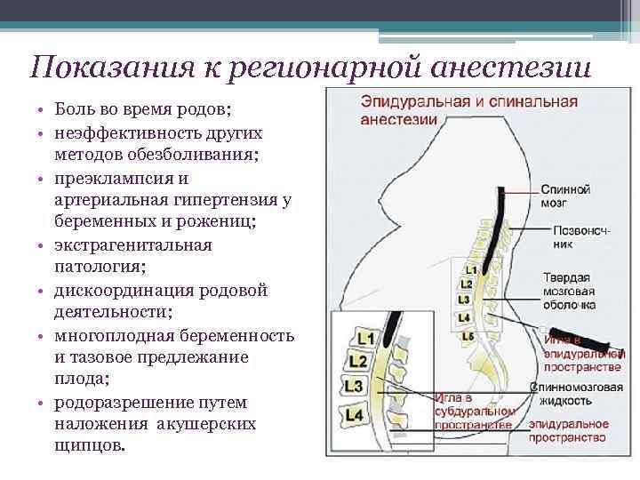 Эпидуральная анестезия - медицинский портал eurolab