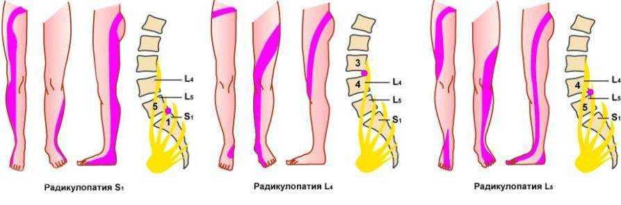 Распространенный остеохондроз: симптомы, диагностика и методы лечения