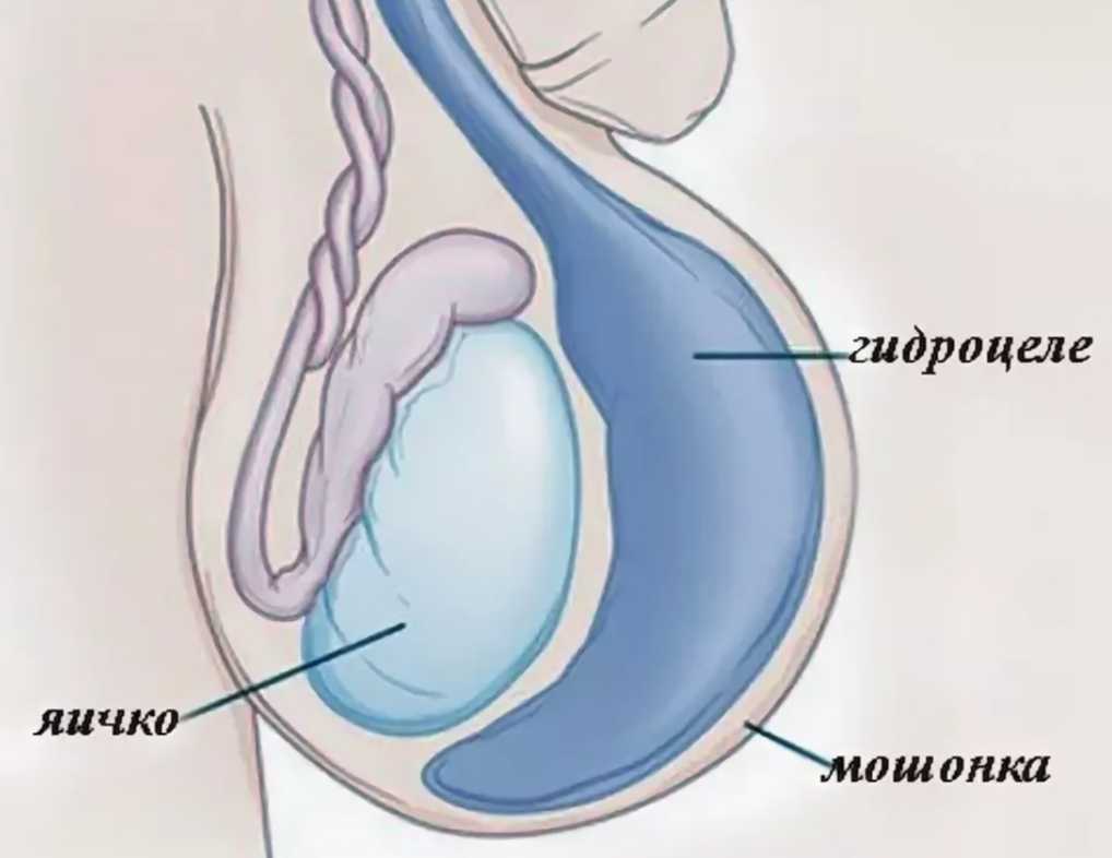Водянка яичка у мужчин картинки