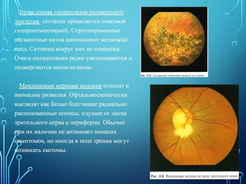 Скотомы - пустые области в поле зрения