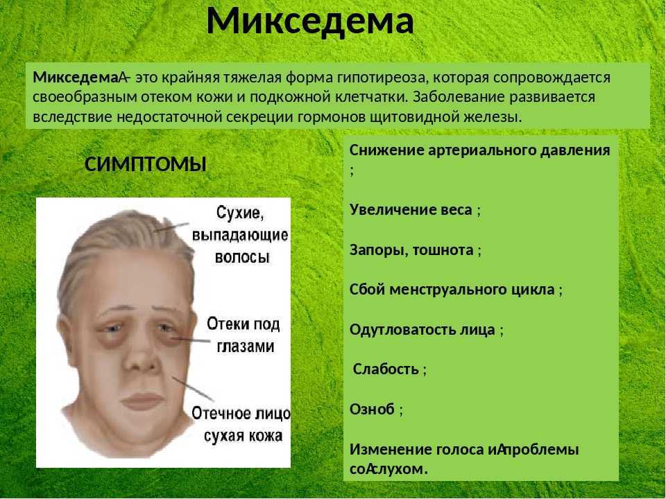 Тиреоидит