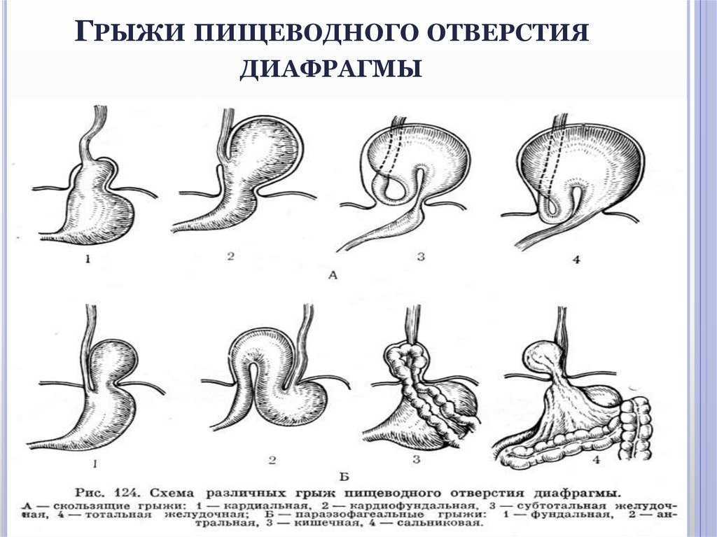 Эндоскопическая картина гпод