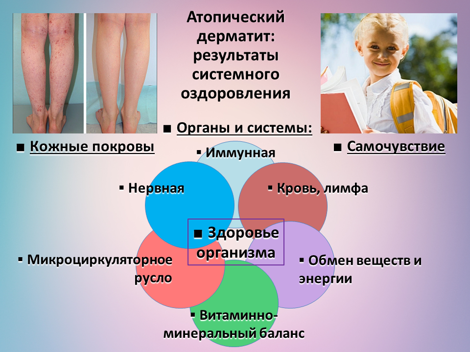 Нейродермит — симптомы, лечение, профилактика | «восьмая клиника»