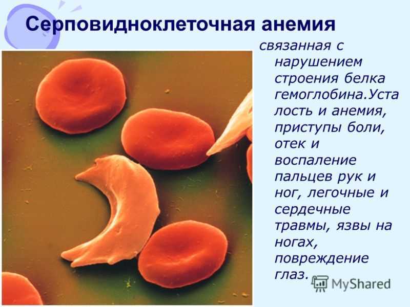 Серповидноклеточная анемия какая. Серповидная анемия эритроциты. Серповидная клеточная анемия причины. Серповидноклеточная анемия эритроциты форма. Серповидноклеточная анемия форма гемоглобина.
