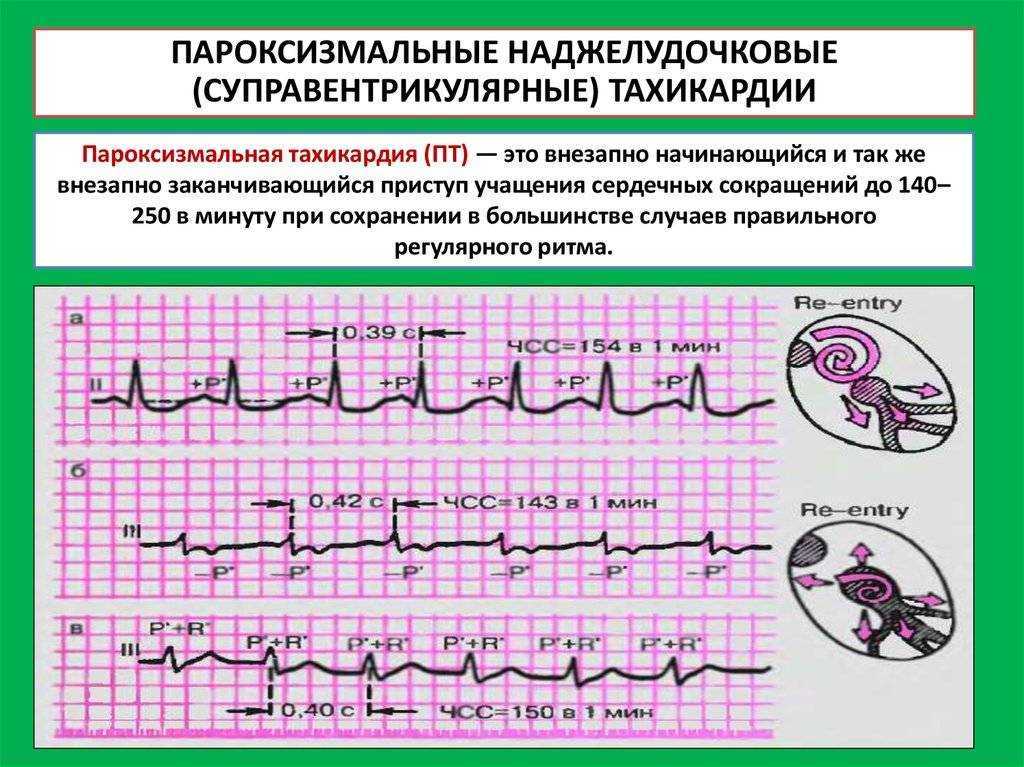 Нарушения сердечного ритма. виды, причины и опасность аритмий