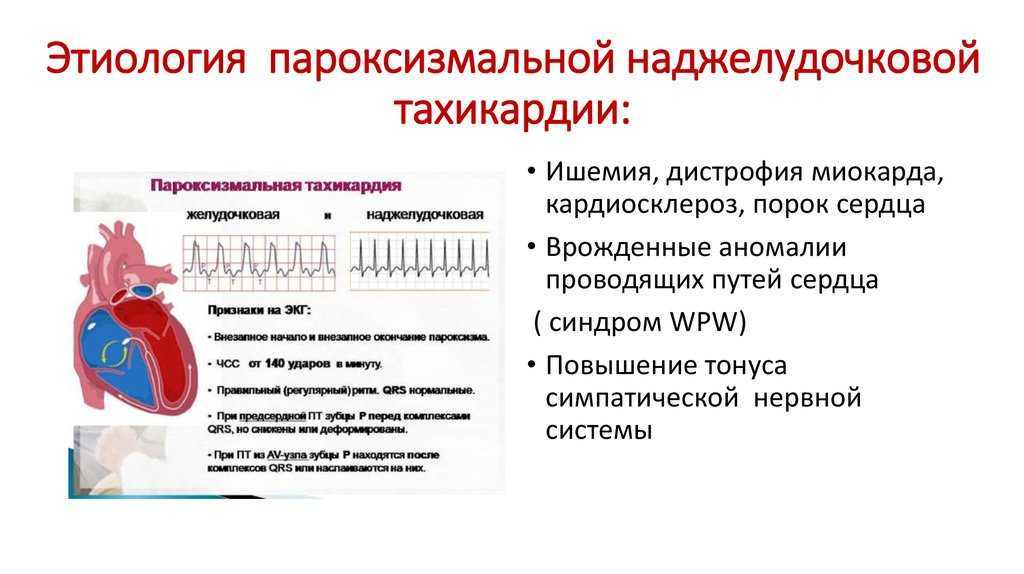 Пароксизмальная наджелудочковая тахикардия. Желудочковая пароксизмальная тахикардия патогенез. Этиология наджелудочковой пароксизмальной тахикардии. Пароксизмальная наджелудочковая тахикардия патогенез. Пароксизмальная суправентрикулярная тахикардия патогенез.