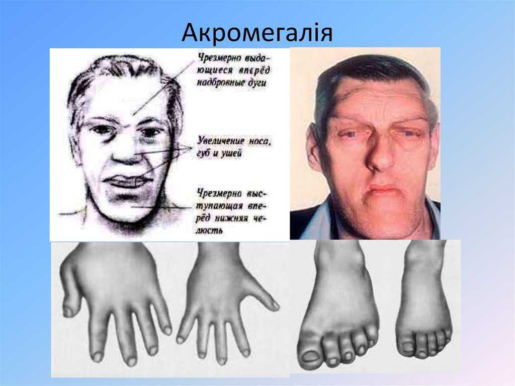 Остеопороз: симптомы и лечение. профилактика и диагностика остеопороза суставов.