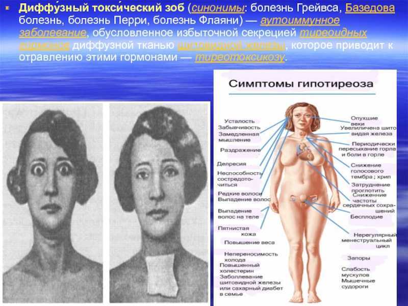 Гипертиреоз: причины, симптомы и лечение | университетская клиника
