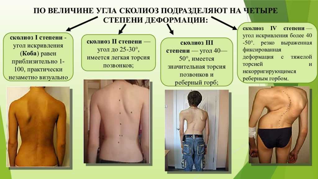 Кифоз — большая медицинская энциклопедия