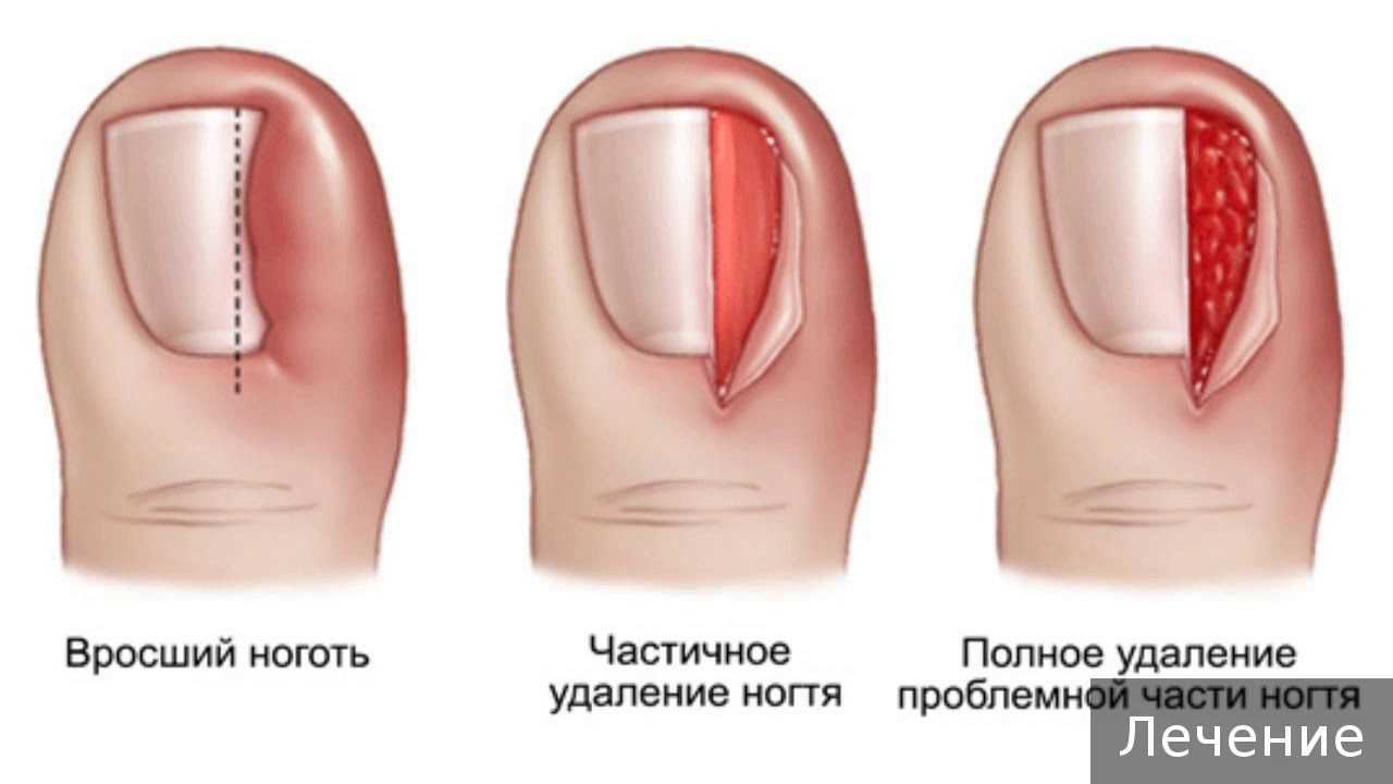 Полностью частично. Онихокриптоз вросший ноготь. Вросший ноготь анатомия. Онихокриптоз операция. Клиновидная резекция ногтевого ложа.