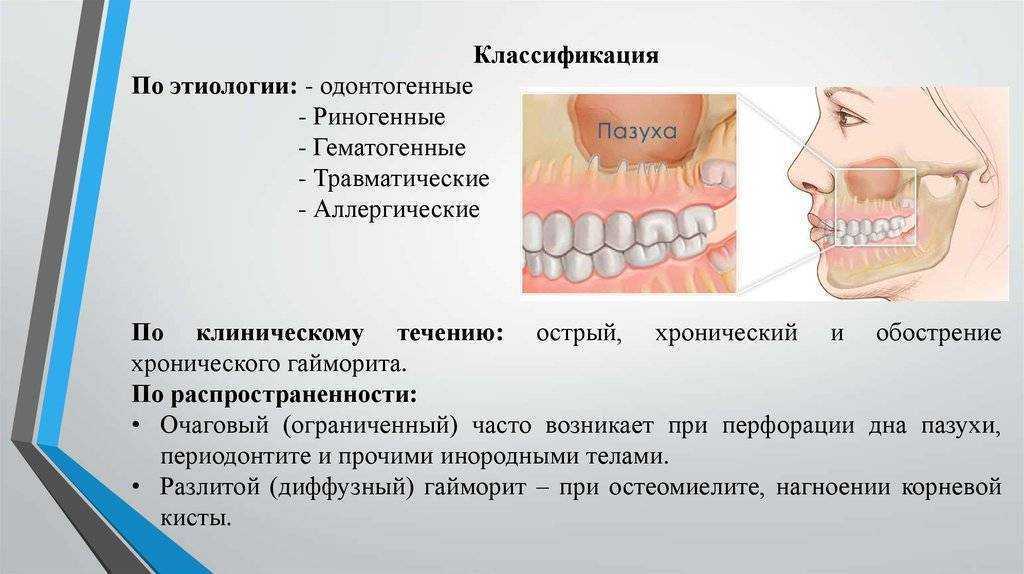 Одонтогенный гайморит. Одонтогенный гайморит верхнечелюстной пазухи. Одонтогенный синусит верхнечелюстной пазухи. Верхнечелюстной синусит классификация. Одонтогенный верхнечелюстной синусит классификация.