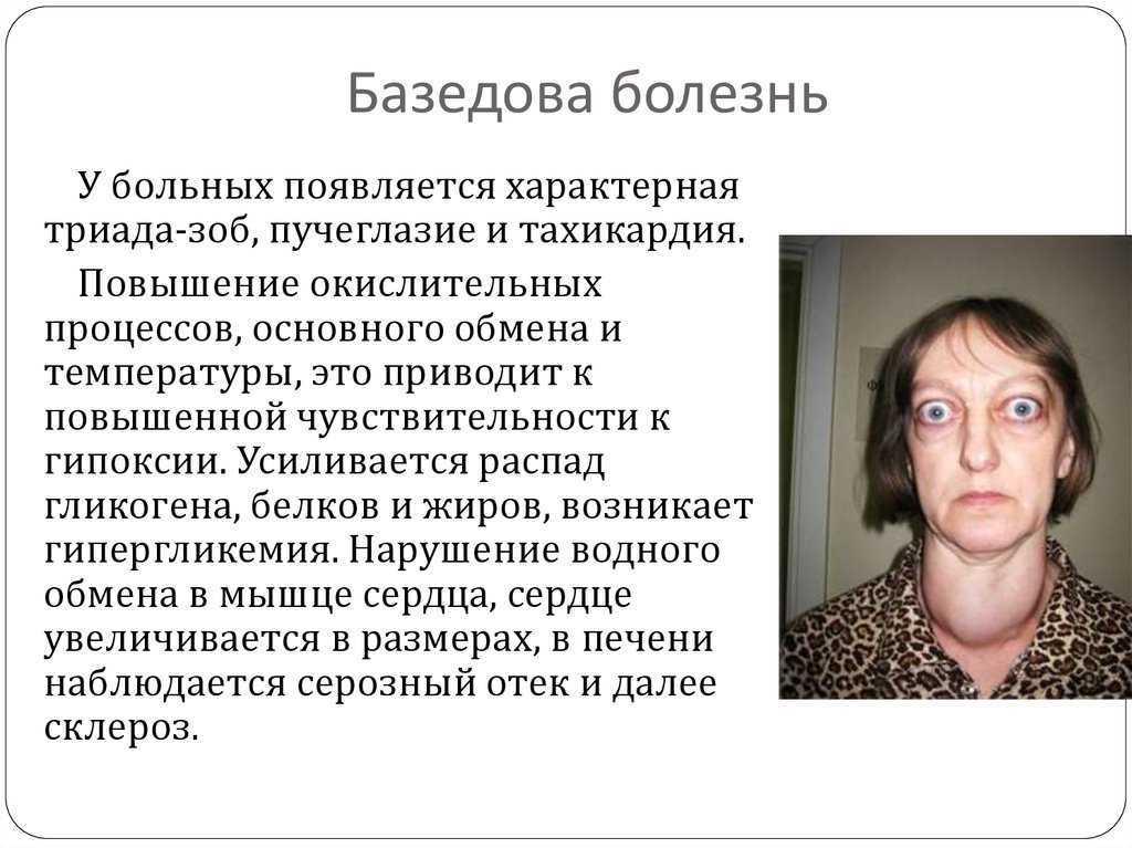 Диффузный токсический зоб щитовидной железы (болезнь базедова): симптомы, причины и лечение