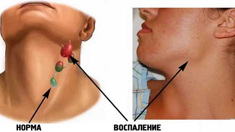 Лечение инфекционного мононуклеоза у детей и взрослых