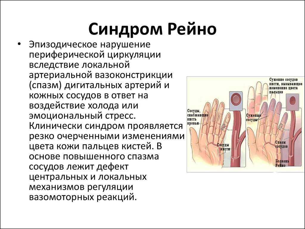 Синдром рейно в практике эндокринолога | паневин | ожирение и метаболизм