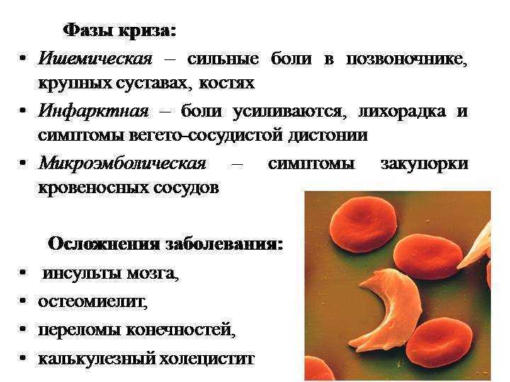 Серповидноклеточная анемия какая. Серповидноклеточная анемия у детей клиника. Серповидно клеточная анемия клиника. Серповидноклеточная анемия этиология. Серповидноклеточная анемия плейотропия.