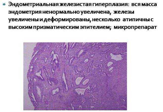 Фото железистой гиперплазии эндометрия