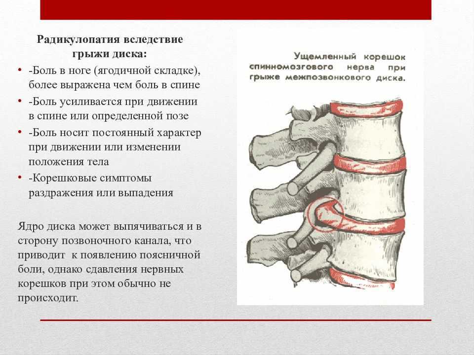 Пояснично крестцовый радикулит карта вызова смп