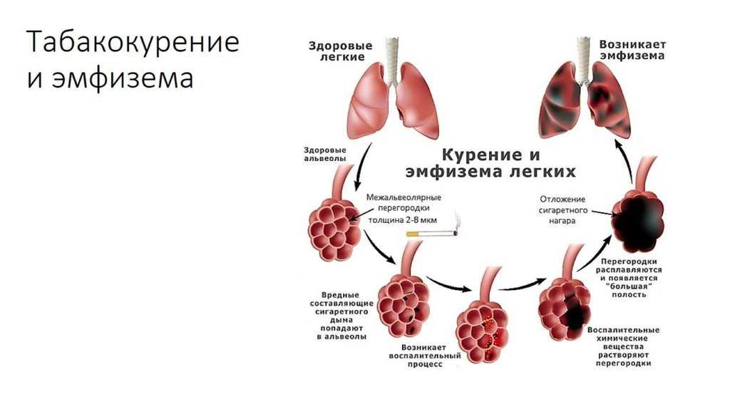 Эмфизема легких симптомы