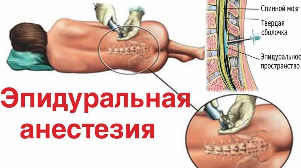 Эпидуральная анестезия - этапы анестезии, механизм действия анестезии, осложнения и последствия :: polismed.com