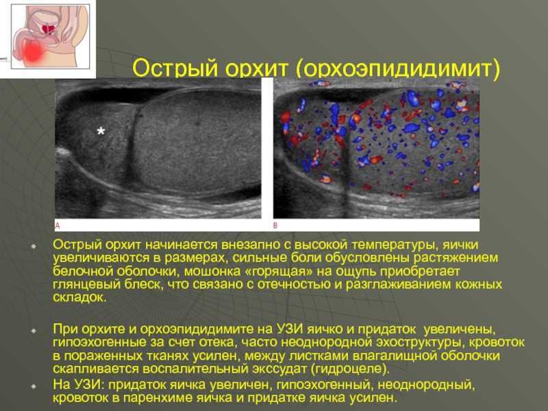Простатит