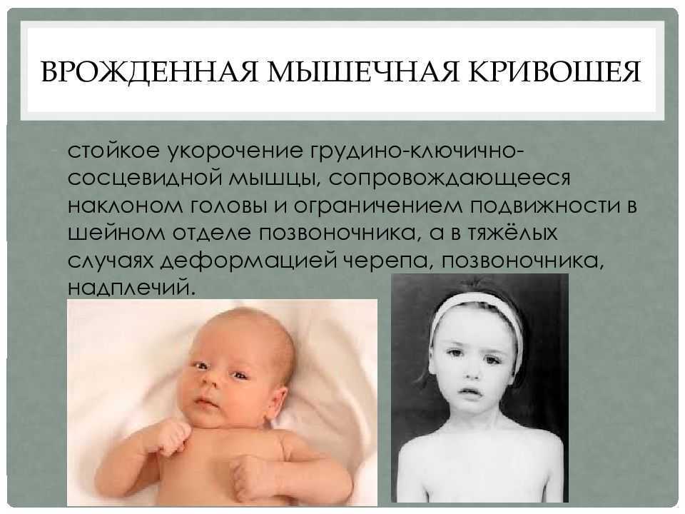 Что такое кривошея у новорожденного ребенка и детей до года: признаки, симптомы, причины, лечение в домашних условиях, комплекс упражнений