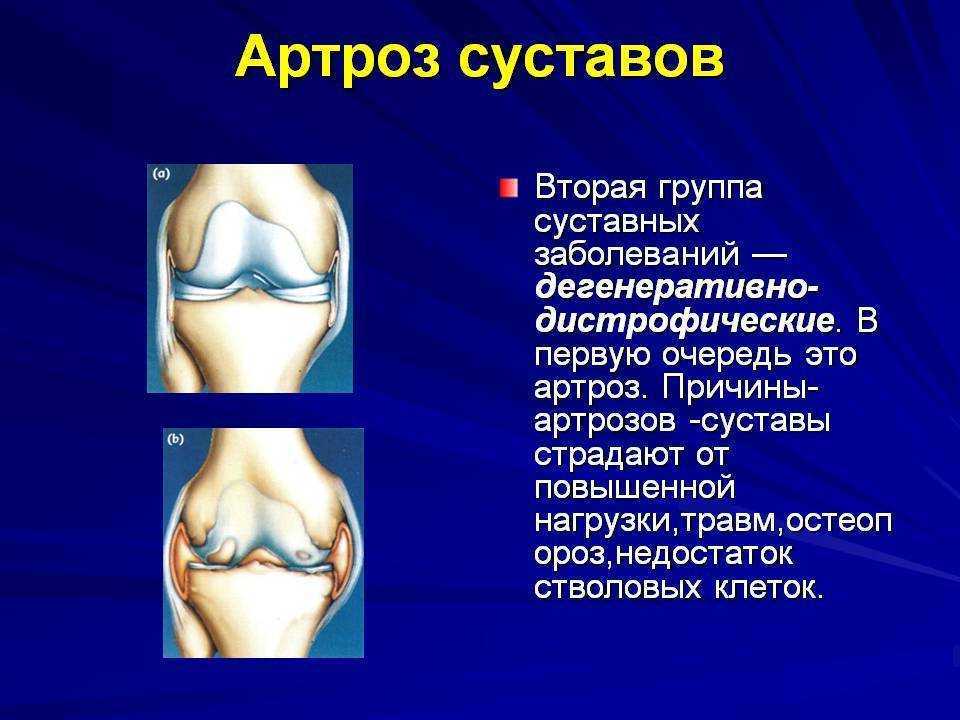 Заболевание коленного сустава артроз. Остеоартрит коленного сустава синдромы. Остеоартроз презентация. Деформирующий артроз презентация. Разрушение хряща и костей коленного сустава.