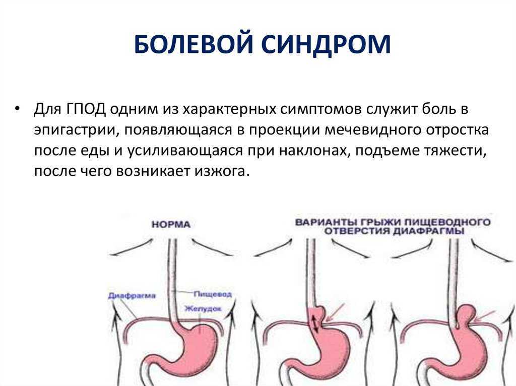 Эндоскопическая картина при грыжах пищеводного отверстия диафрагмы характеризуется