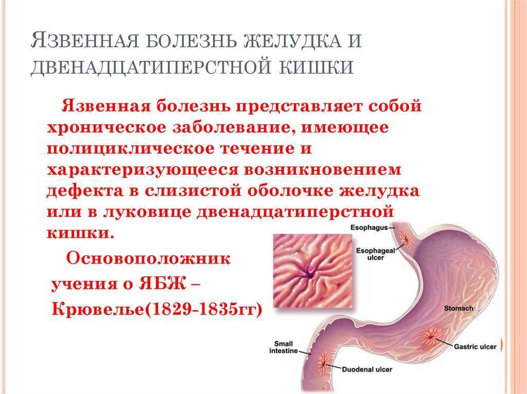 Язвенная болезнь двенадцатиперстной кишки картинки