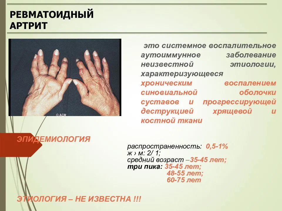 Схема лечения ревматоидного артрита у взрослых