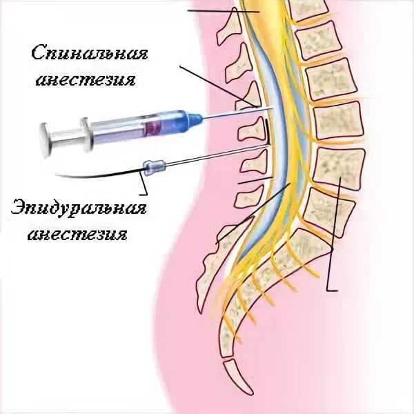 Эпидуральная анестезия