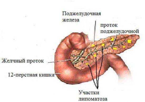 Диффузные изменения поджелудочной железы у взрослого