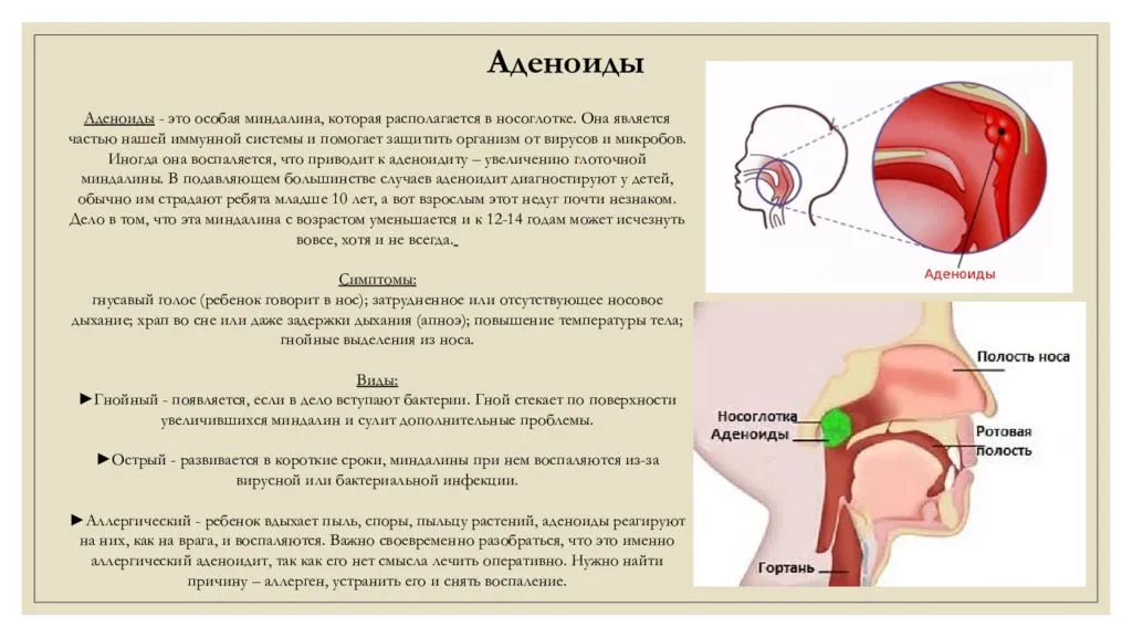 Гланды и аденоиды картинки где находятся