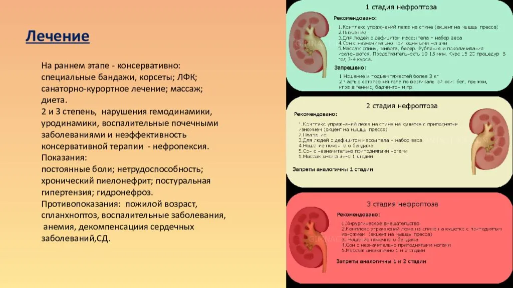 Опущение почки (нефроптоз)