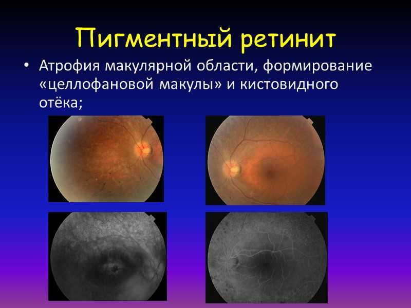 Воспаление сетчатки. Пигментная дегенерация сетчатки. Пигментного ретинита (абиотрофии сетчатки. Белоточечный пигментный ретинит. Тапеторетинальная дистрофия сетчатки.