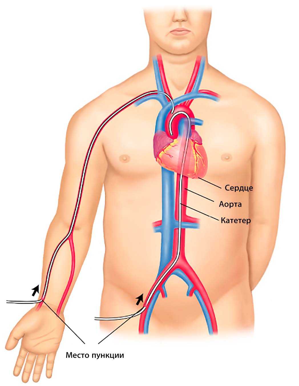 Сердечный через. Коронарография через бедренную артерию. Катетер в аорту через бедренную артерию. Катетеризация сердца через бедренную артерию. Стент через бедренную артерию на сердце.