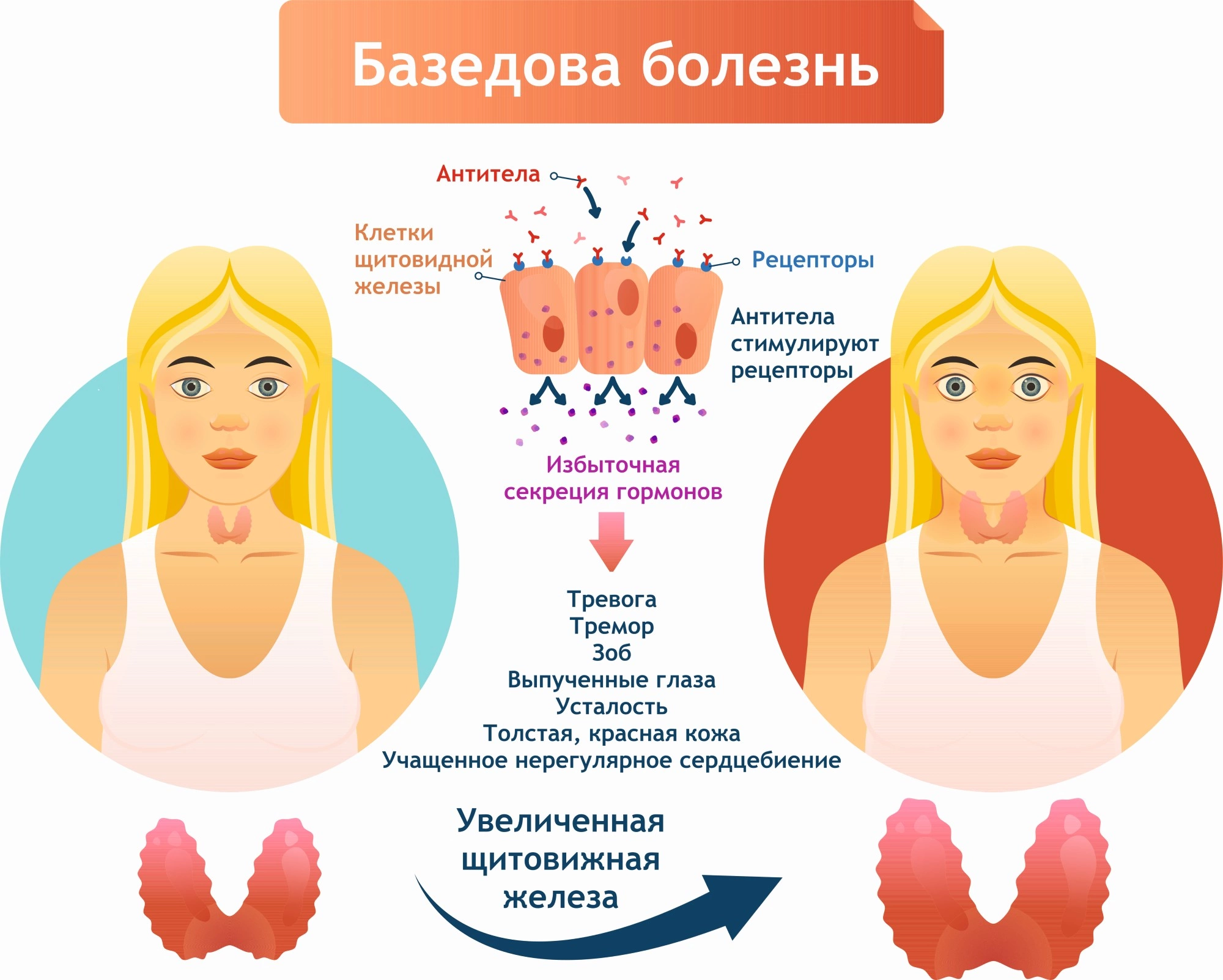 Заболевание дав. Заболевание щитовидной железы у детей буклет. Характерный признак базедовой болезни 2 а 4 к.