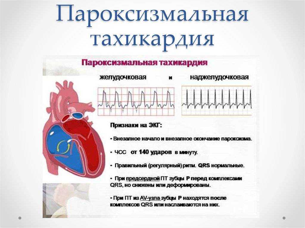 Тахикардия: причины, симптомы, лечение. виды тахикардии