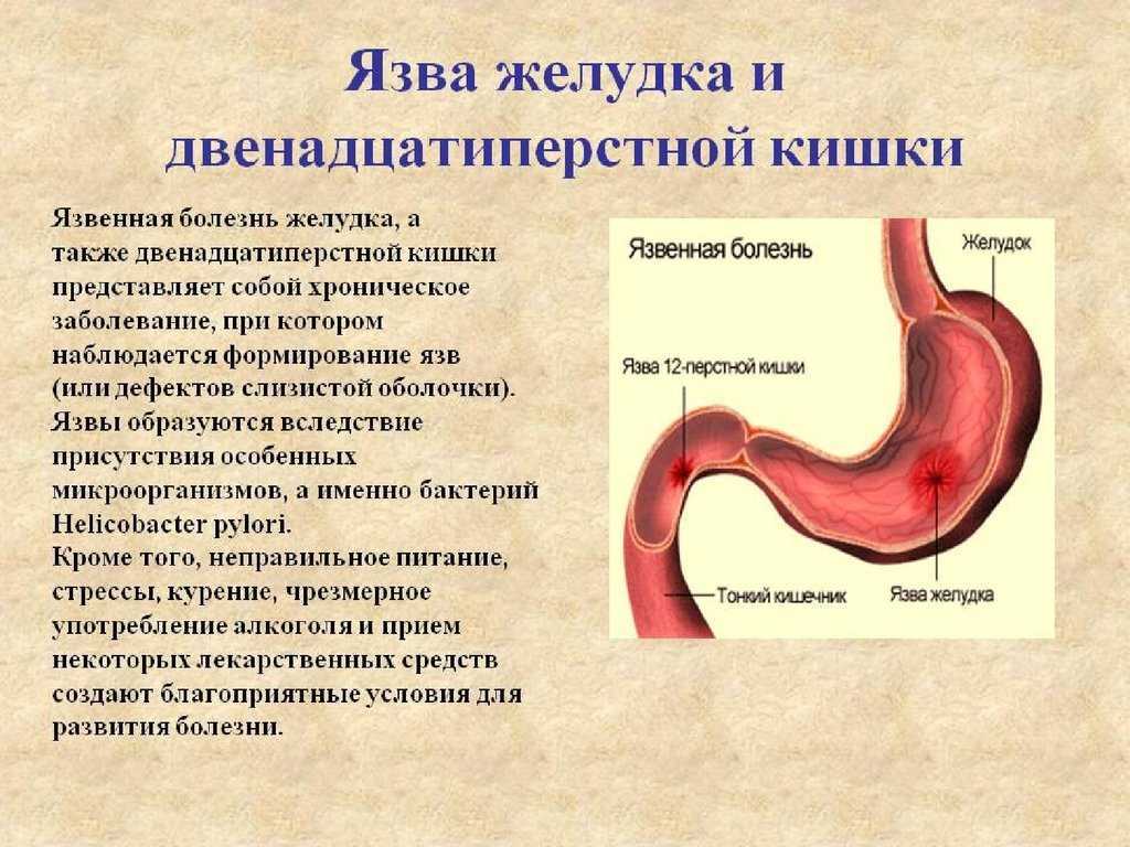 Язвенная болезнь двенадцатиперстной кишки картинки