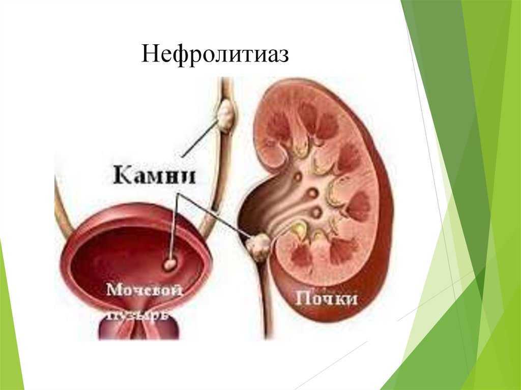 Признаки камней в почках. Мочекислый нефролитиаз. Мочекаменная болезнь (нефролитиаз). Билатеральный нефролитиаз что это.